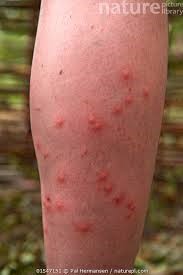 Mosquito bites all over a woman's leg needing mosquito control